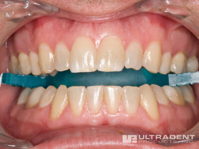 Boost tooth whitening is an in-office treatment system.