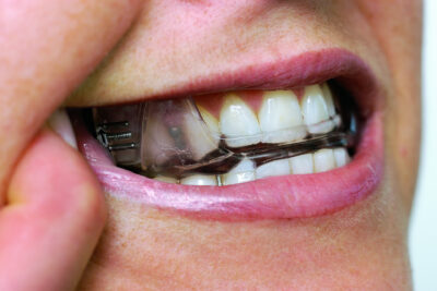 Oral appliances resolve mild to moderate sleep apnea in most patients. Talk to our Placerville dentists for more information.