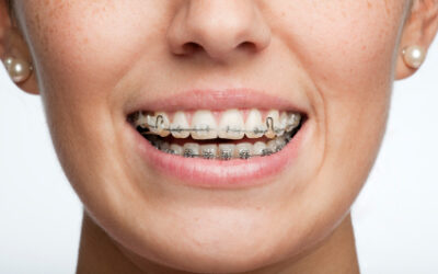 If You Wear Braces…