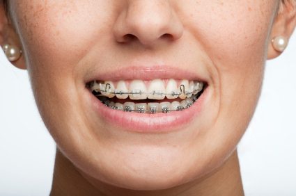 Braces