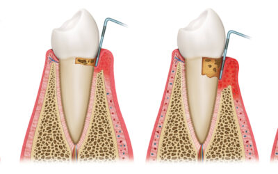 How to Fight Gum Disease