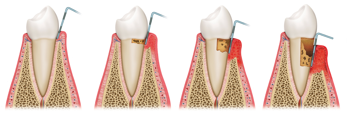 How to Fight Gum Disease