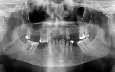 What to Do if You Lose a Crown or Filling