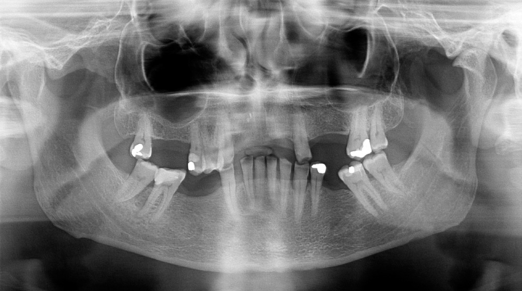 A mouth with dental repairs, all of which can be fixed by our Placerville dentists.