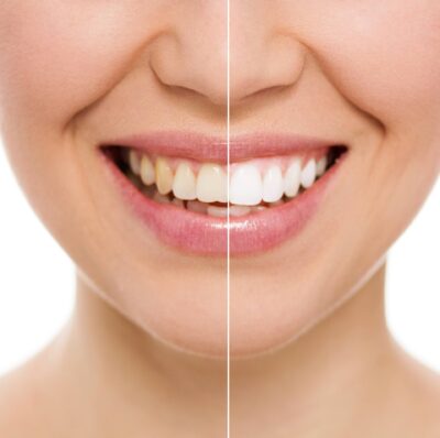Tooth whitening using standard methods is effective and gradual when purchased from the Placerville Dental Group.