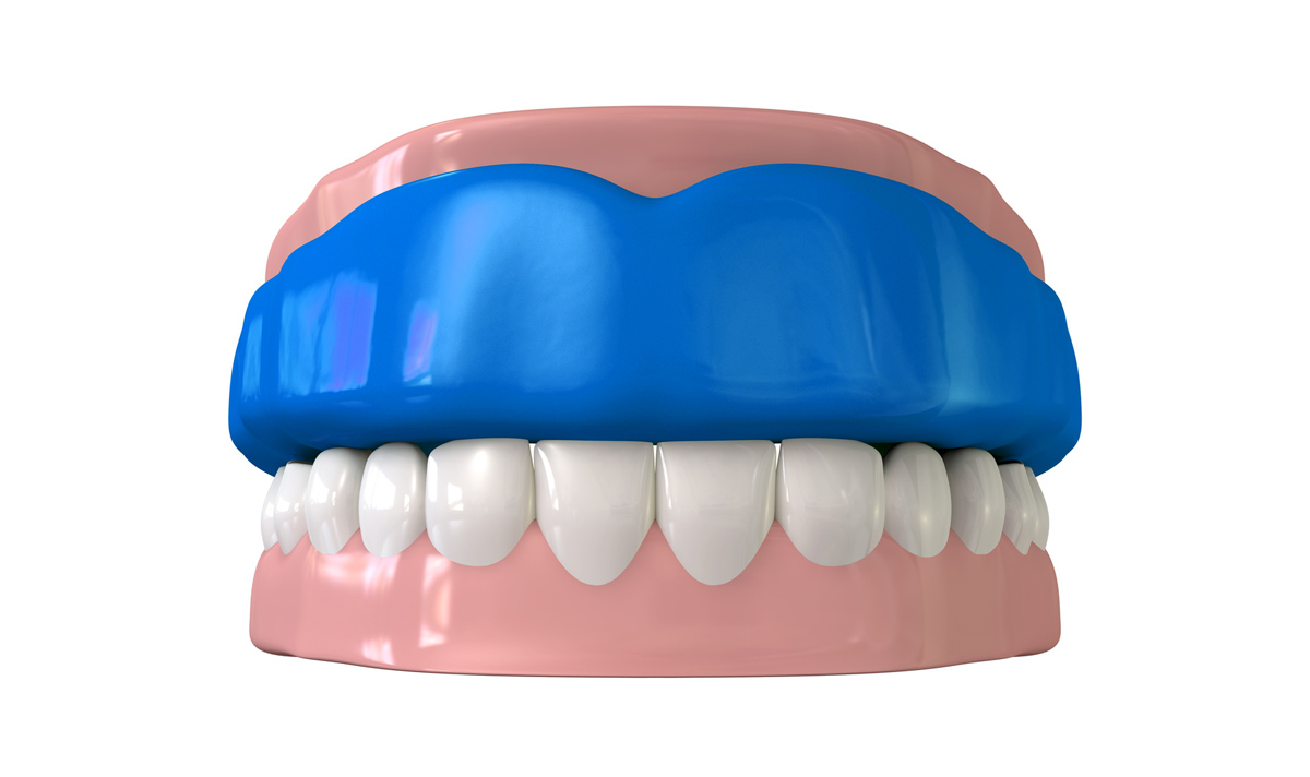 A customized mouthguard protects your teeth from outside forces and nightime or daytime teeth grinding.