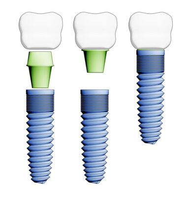 The components of dental implants.