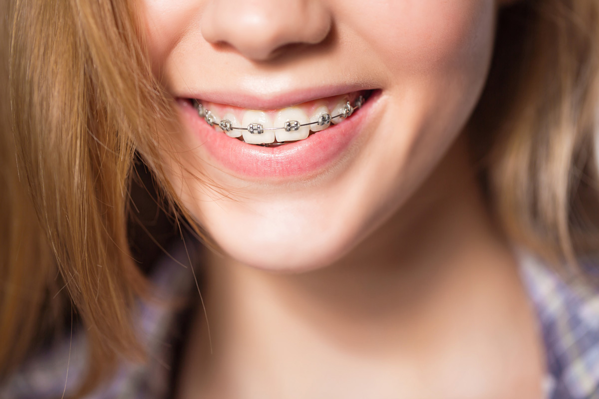 Braces