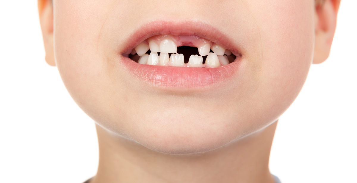 Jagged teeth are called mamelons and they do not require a visit to our Placerville dentists.