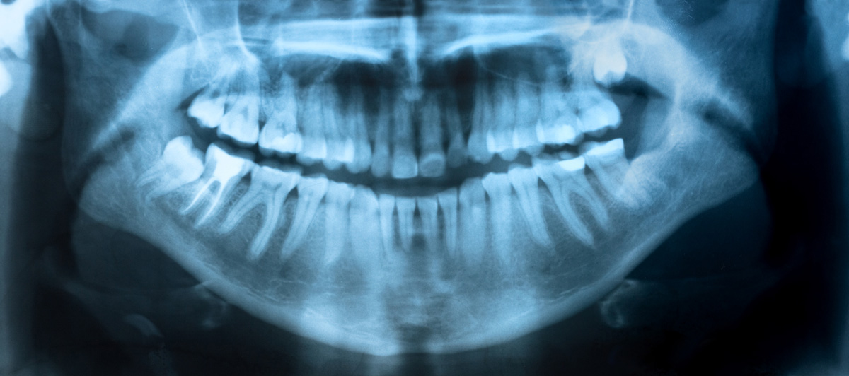 An impacted wisdom tooth damages its neighbor from below.