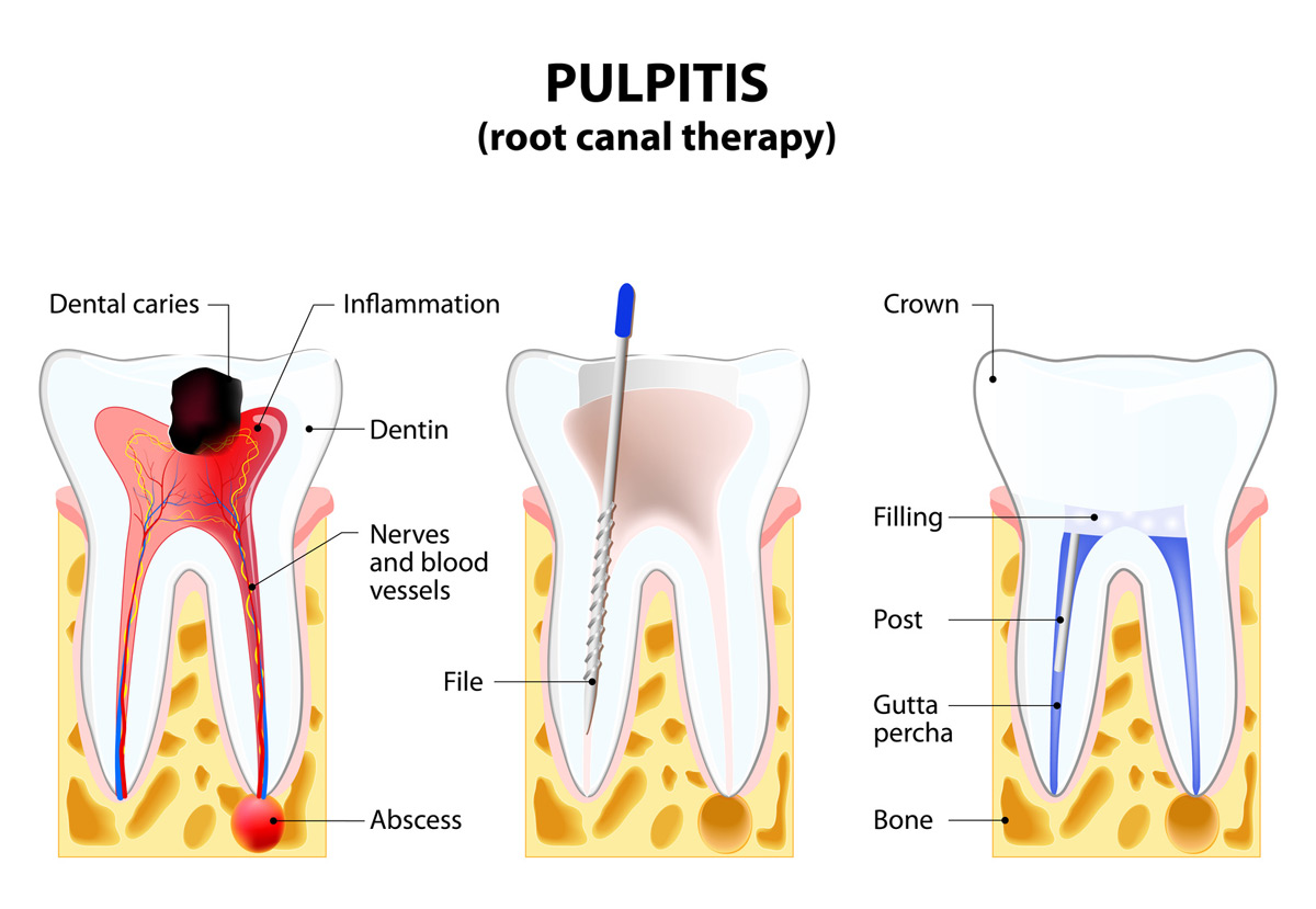 Our Placerville dentists perform root canals to save infected teeth.