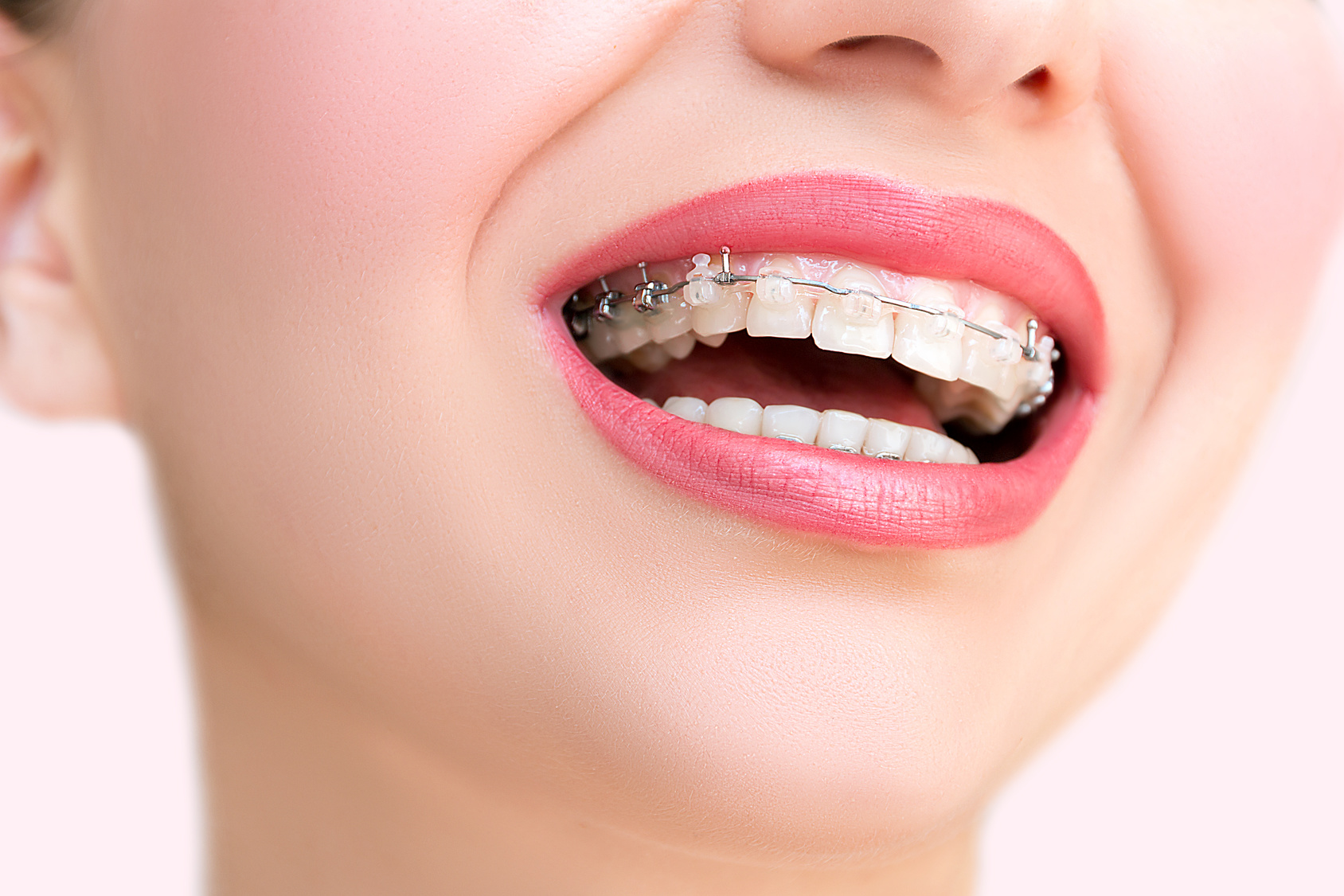 Close up Ceramic and Metal Braces on Teeth. Beautiful Female Smile with Self-ligating Braces. Orthodontic Treatment. 