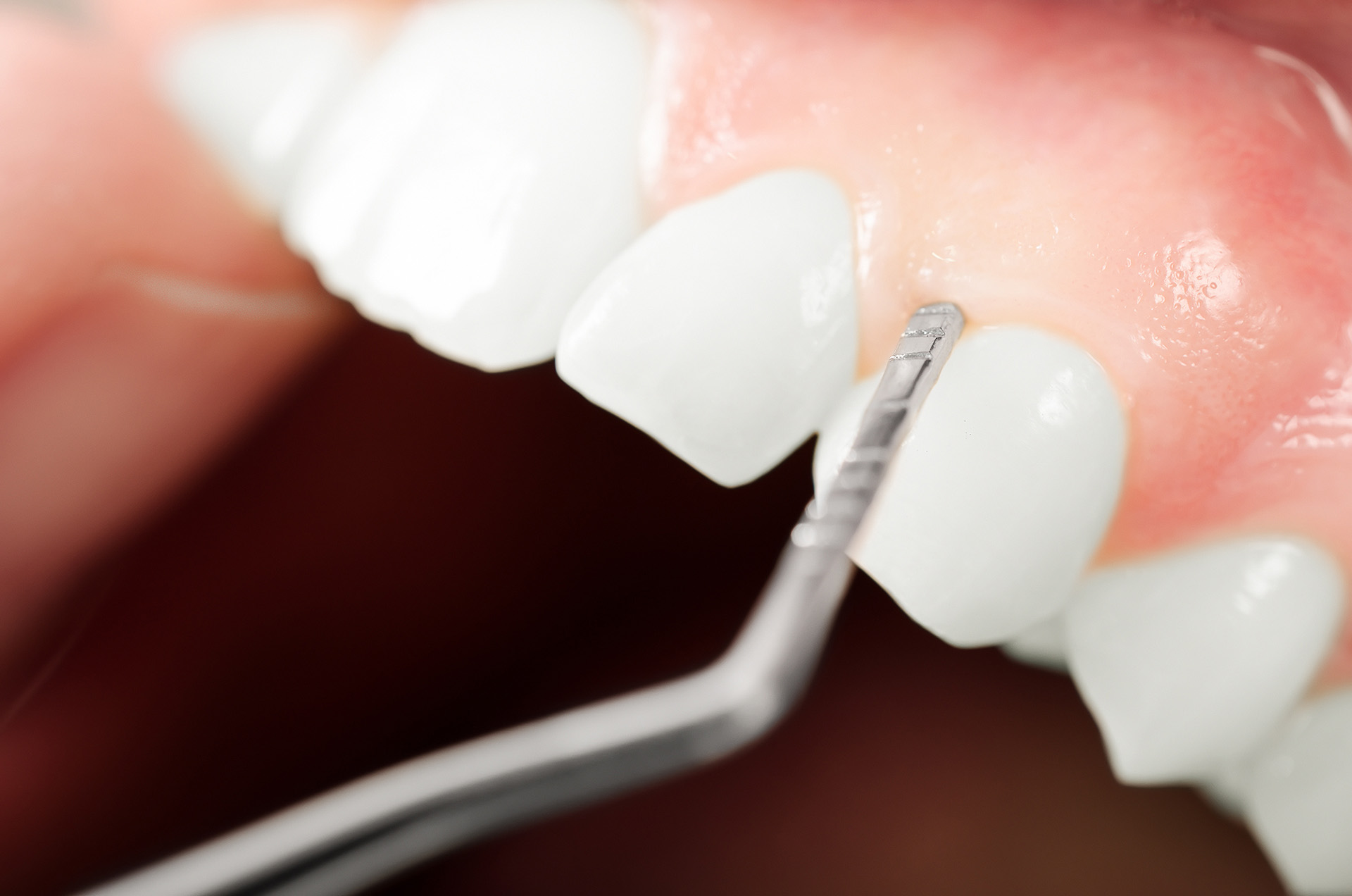 Pinhole Surgical Technique