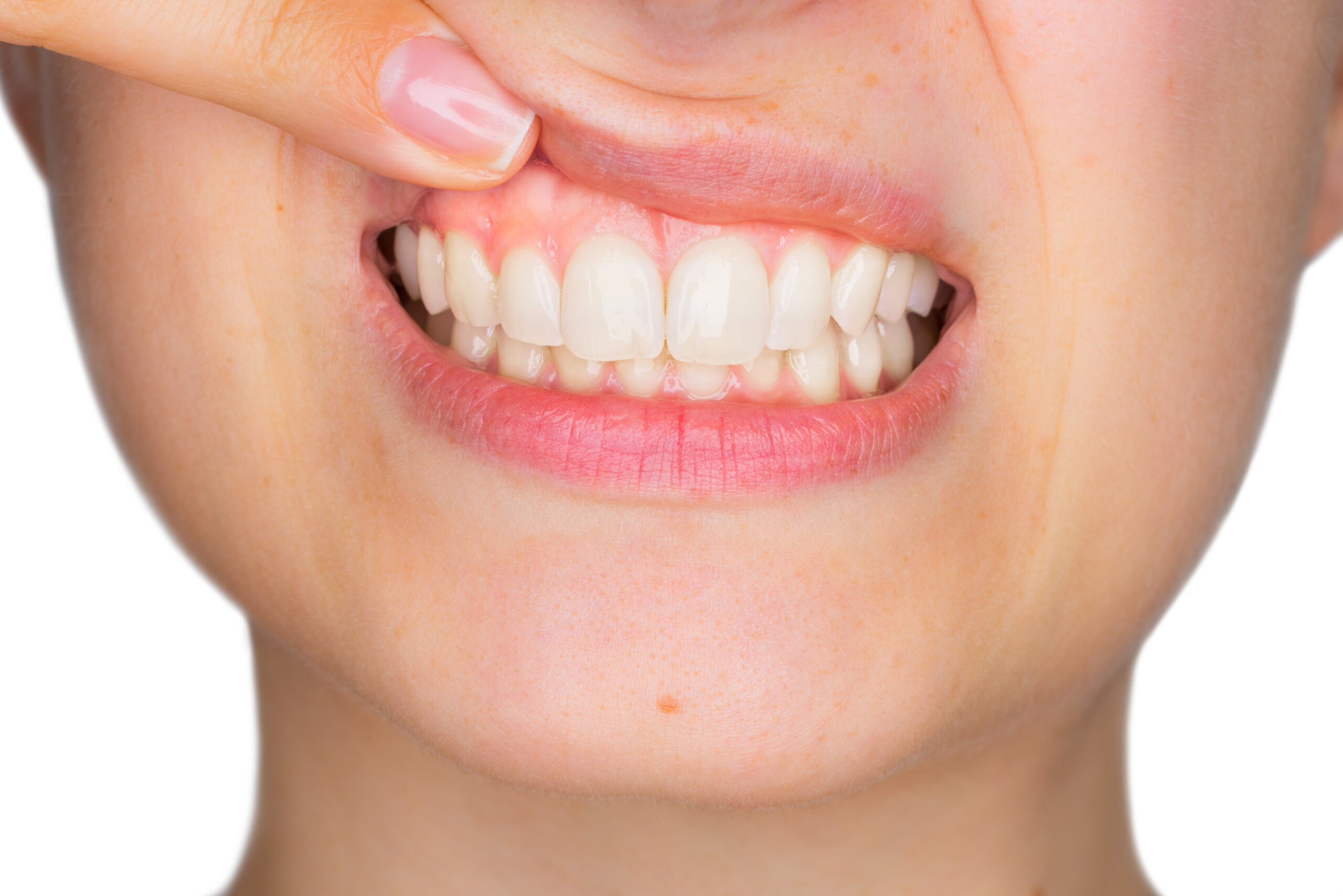 Gum Recession