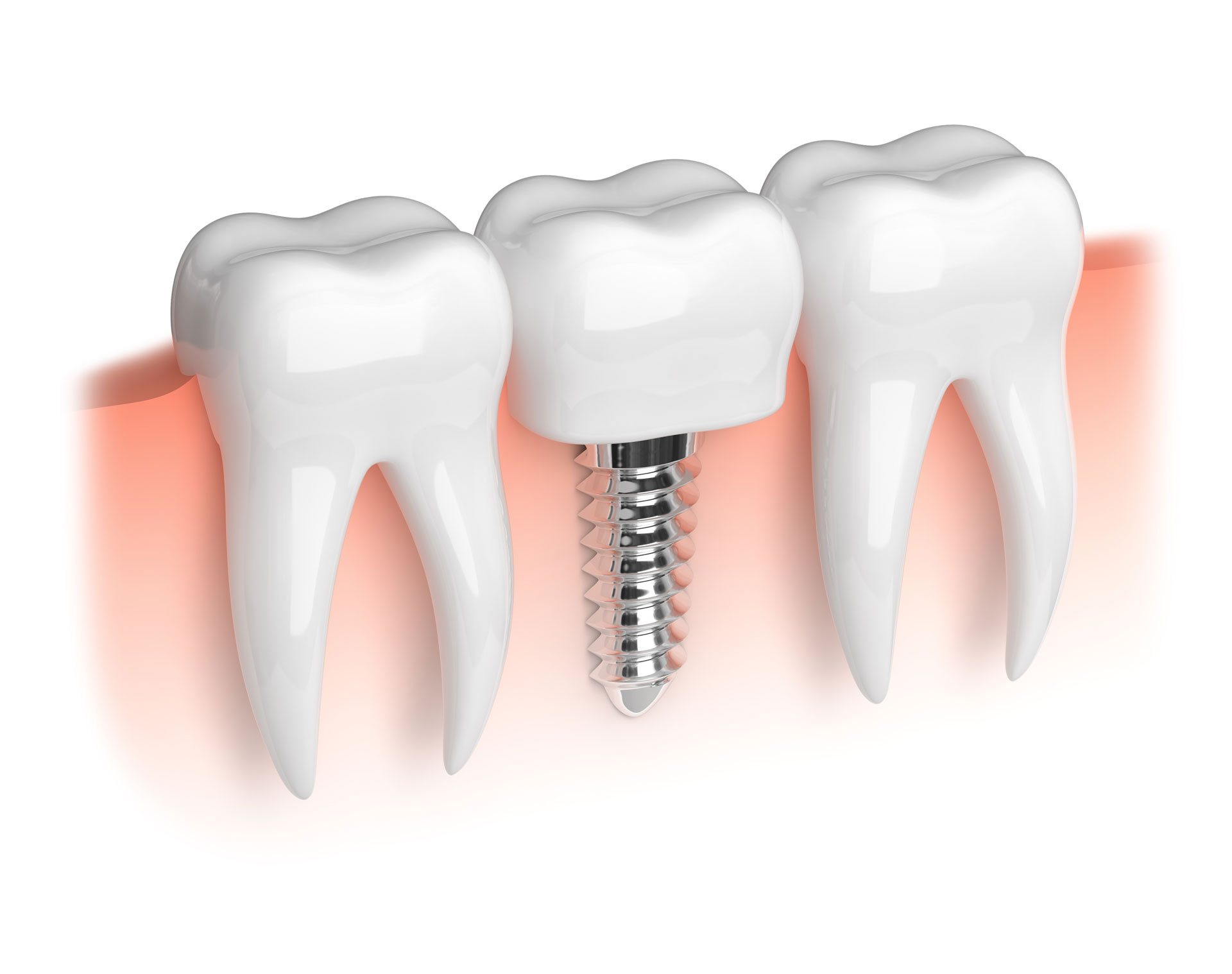 Dental Implants and SSRIs