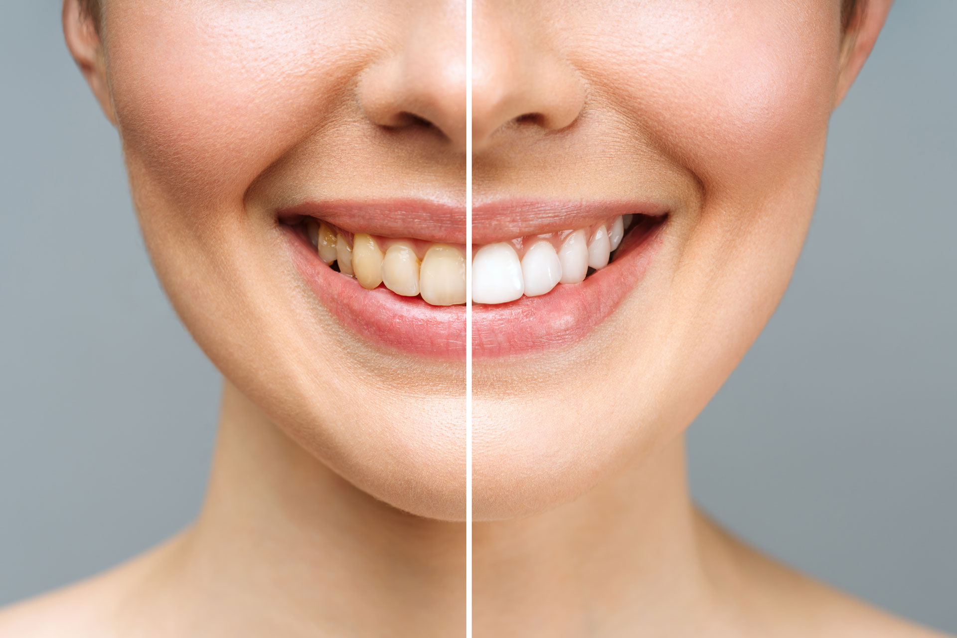 Yellowed Teeth